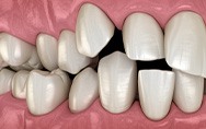 Illustration of spaced out teeth