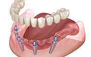 a computer illustration showing how implant dentures work