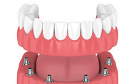 model of implant-supported denture