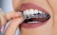 Closeup of patient putting on clear aligner