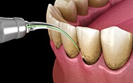 a 3D illustration of laser periodontal treatment