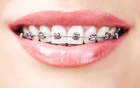 Smile with traditional braces