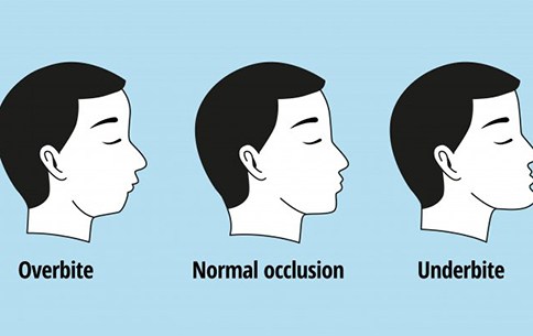 Illustration of alignment issues