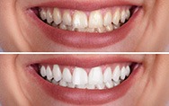 before and after teeth whitening close-up of a smile